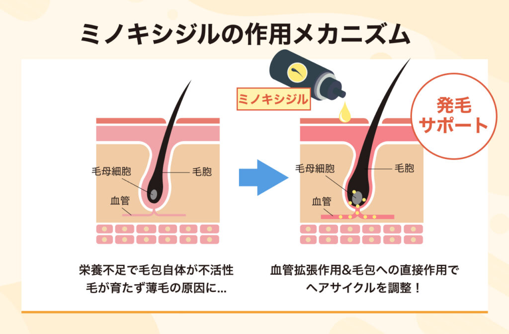 発毛を目的としたプラン (フィナステリド+ミノキシジル内服)